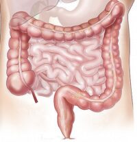 crohn