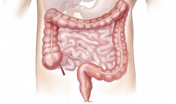 crohn